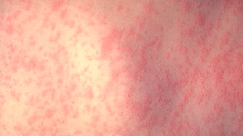 Connecticut’s second measles case of 2026 in Connecticut was confirmed by state health...