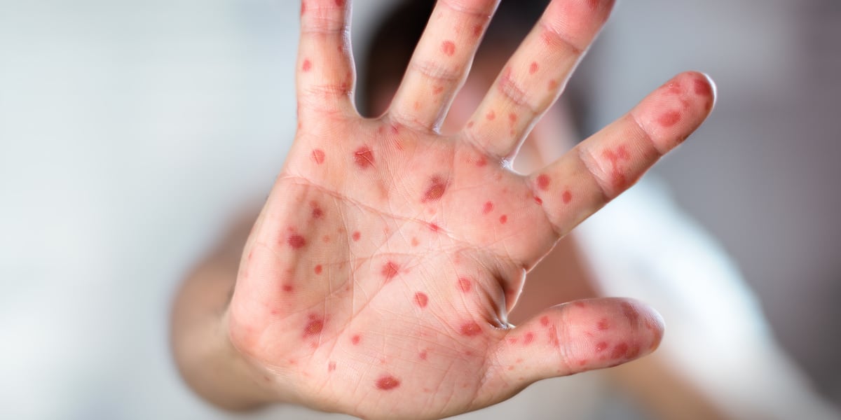 Photo: wfsb.com Connecticut Confirms Third Measles Case of 2026, Highest Since 2019