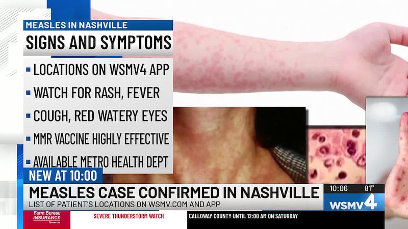 The Metro Public Health Department announced Friday that a case of measles has been confirmed...